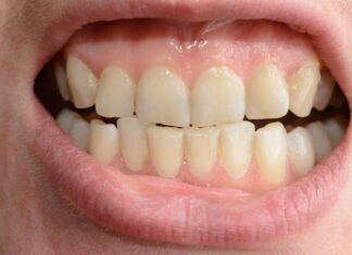 Invisalign: Den diskrete vej til et strålende smil